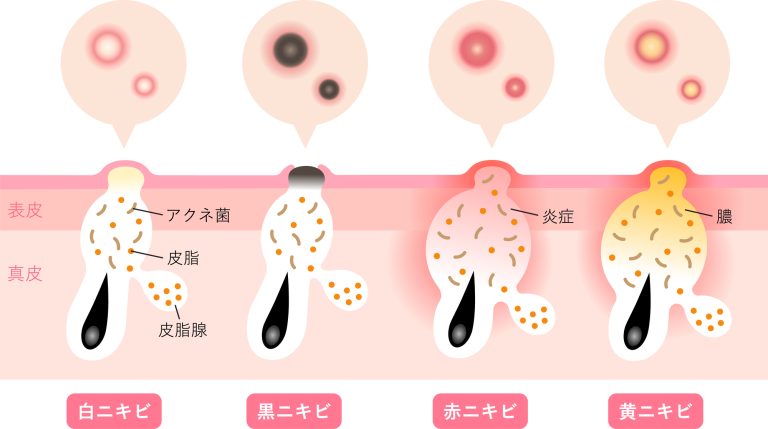 にきび・にきび跡の治療方針